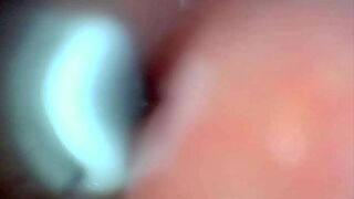 Endoscope camera captures moment of male ejaculation